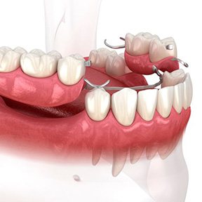 Illustration of partial dentures for lower arch