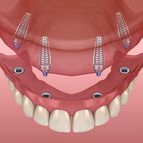 Implant dentures for upper dental arch