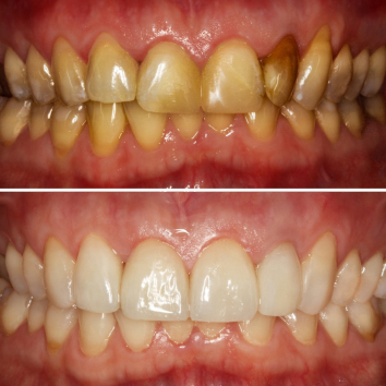 Pictures of teeth before and after cosmetic dental treatment