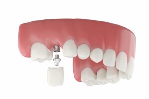 Illustration of dental implant replacing lost molar